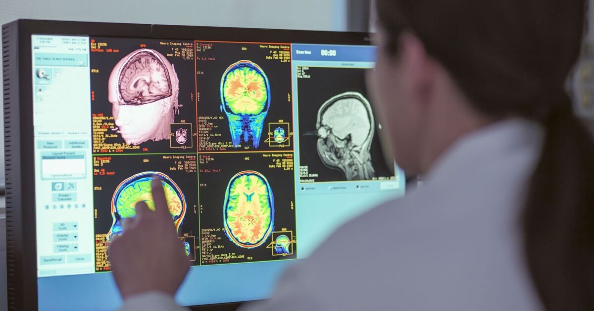 Due farmaci contro il cancro potrebbero invertire i cambiamenti cerebrali causati dall'Alzheimer: spiegazione completa dello studio