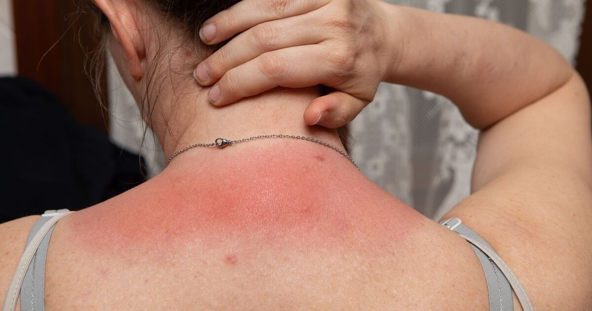 Woman asks for best methods to treat sunburn after 'skin fail'
