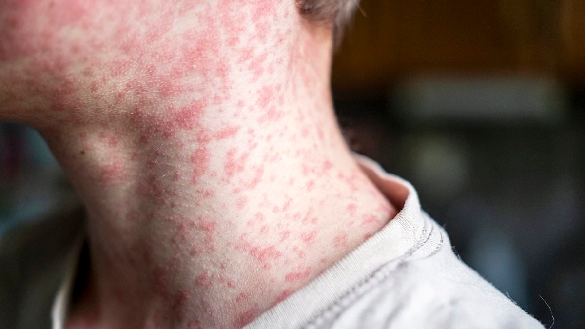 Thousands of people exposed to measles at major sporting event as infections spread