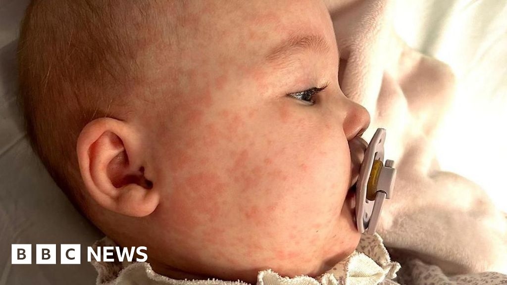 Vaccination plea after baby's 'terrifying' measles