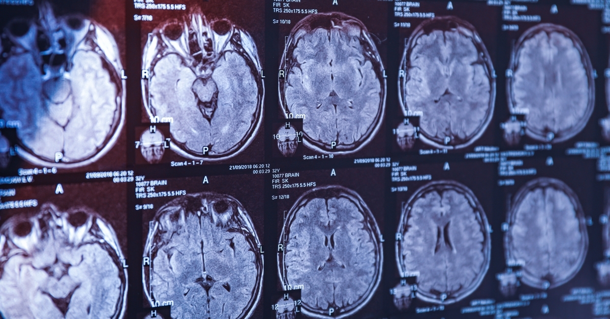 Studie entdeckt genetische Variante, die das Alzheimer-Risiko erhöht