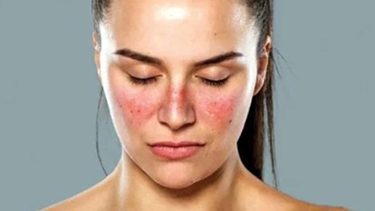 ¡Las manchas en la cara podrían ser un signo de lupus! Puede afectar a muchos órganos.