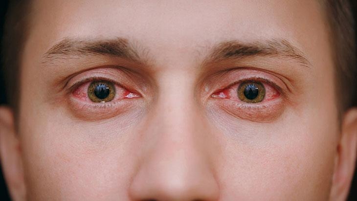 Don't ignore the risks in the summer months! It can cause permanent vision loss