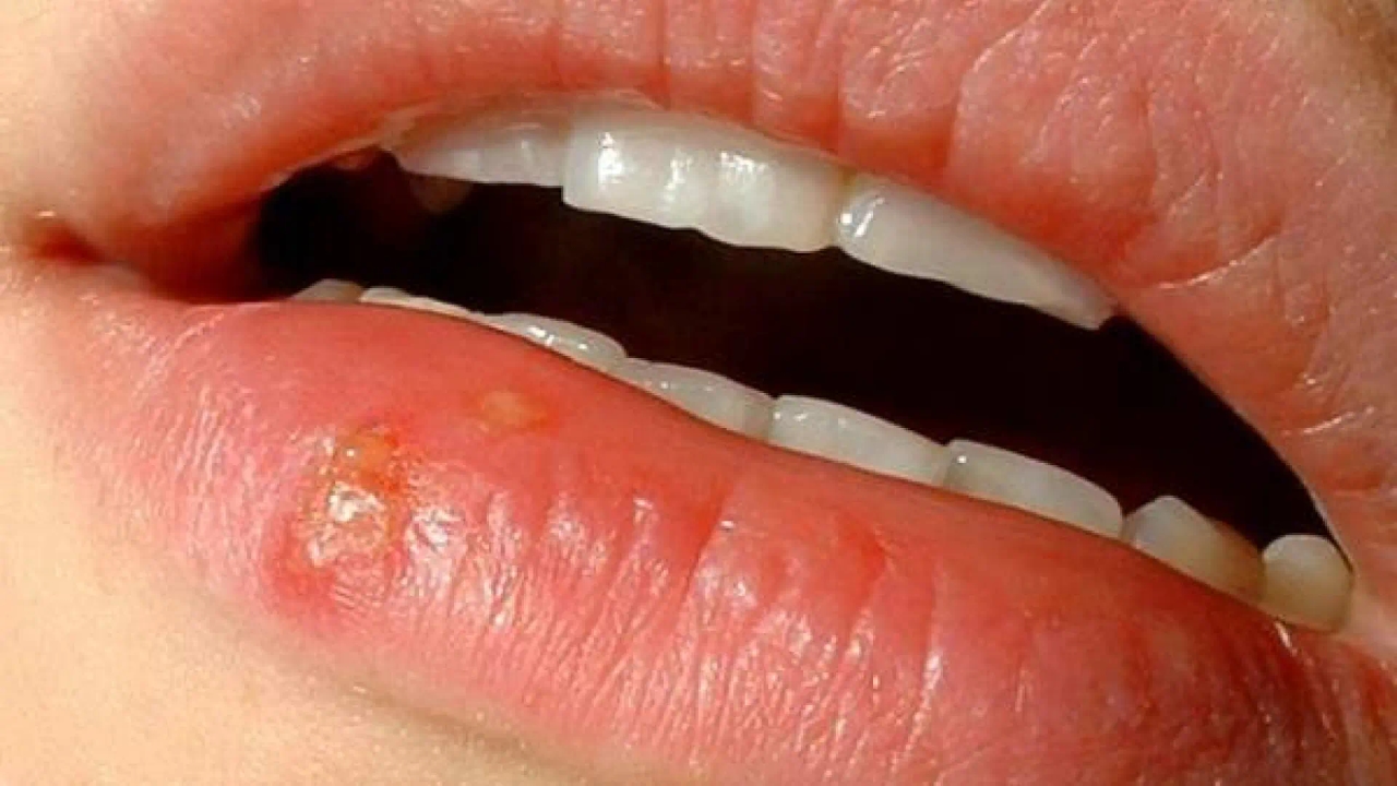 Как вылечить герпес естественным и безопасным способом: эффективные домашние средства