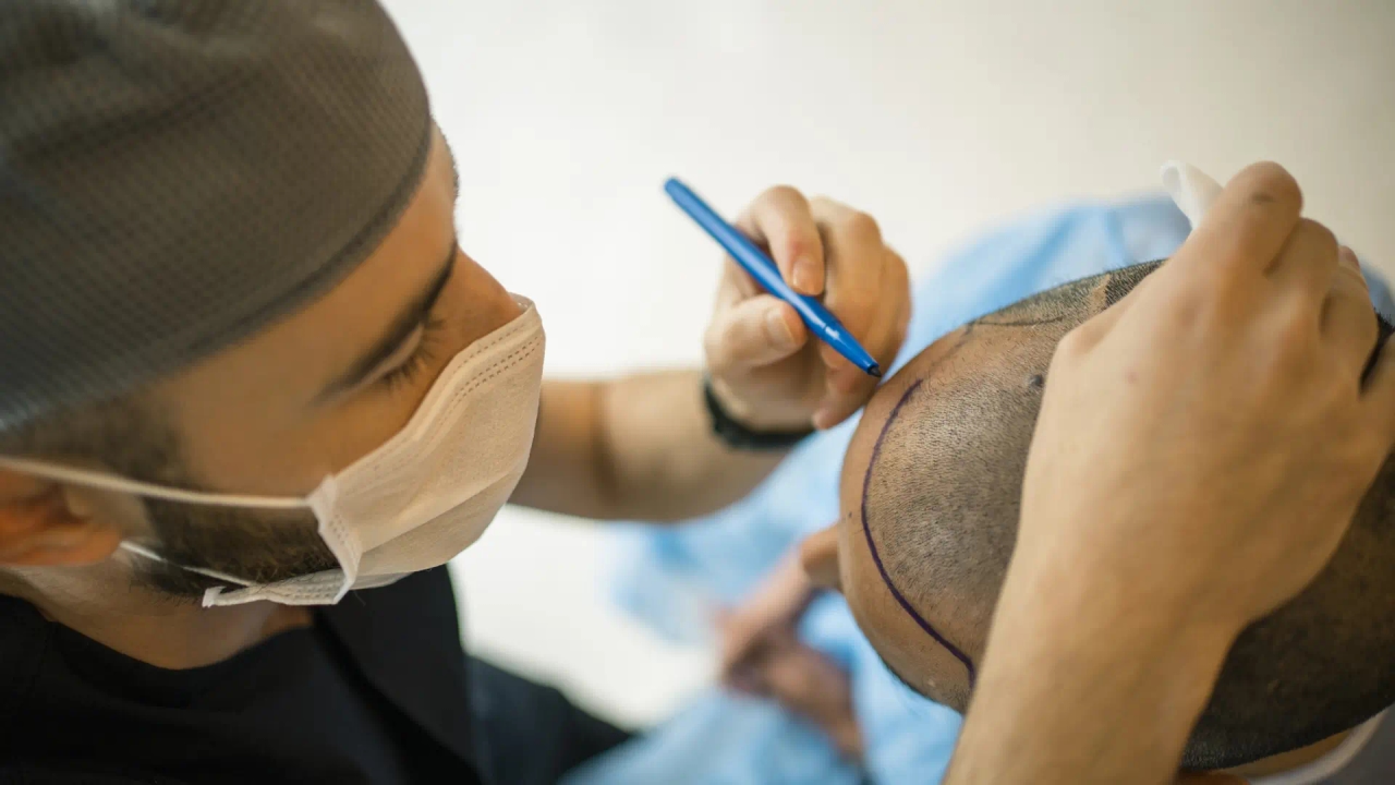 Mann stirbt nach Haartransplantation: Das sind die häufigsten Risiken und Nebenwirkungen