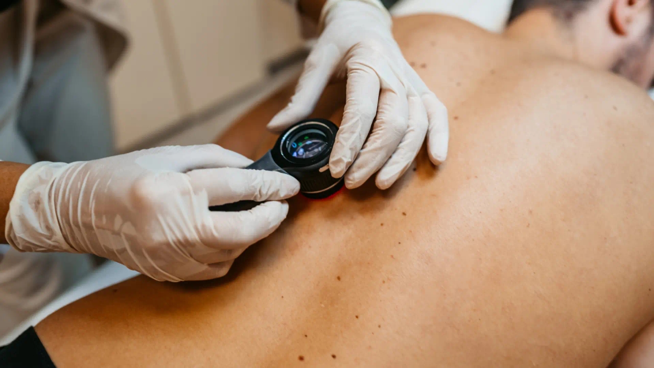 Radioactive gel: This is how the revolutionary skin cancer treatment technique launched in Catalonia works.