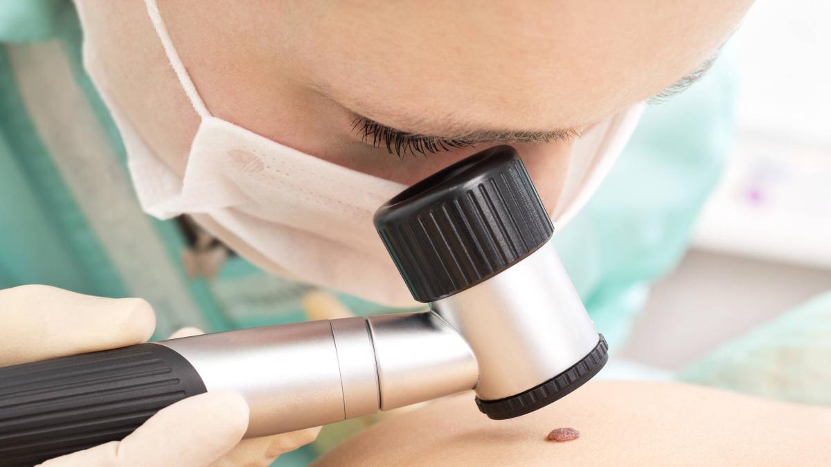 Le diagnosi di cancro alla pelle sono aumentate del 37% a Bogotà: "Alcune persone potrebbero averlo e non saperlo"