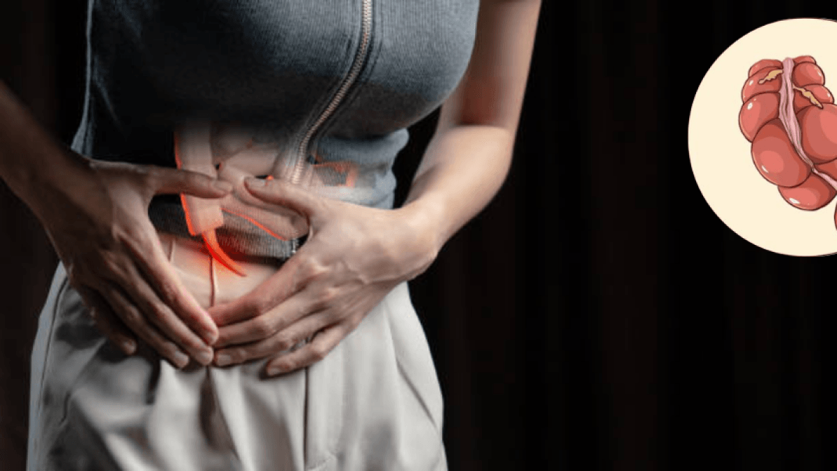 Il cancro all'appendice è in aumento tra i giovani: a quali sintomi bisogna fare attenzione?