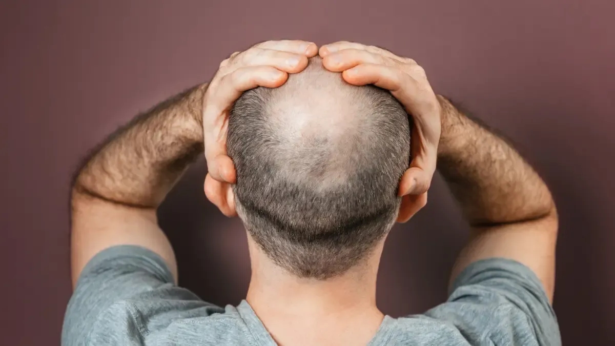 Biofibra, l'impianto di capelli non chirurgico arrivato in Colombia