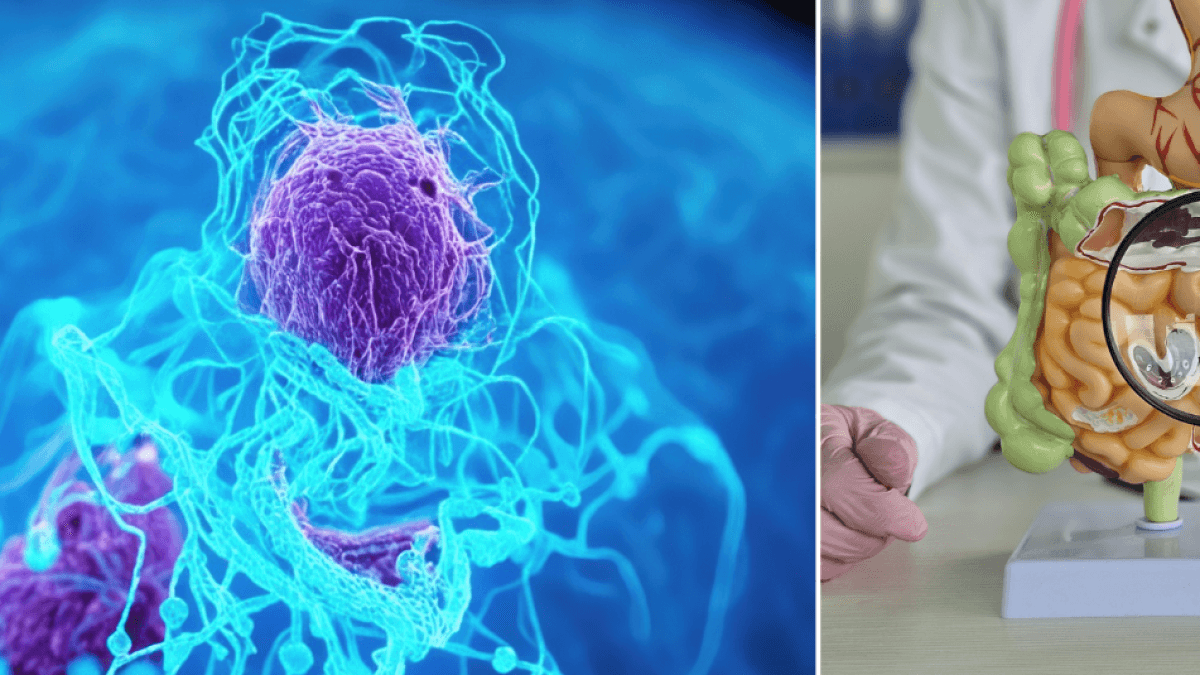 Wissenschaftler entdecken Mechanismus im Körper, der die Entstehung von Dickdarmkrebs auslöst.