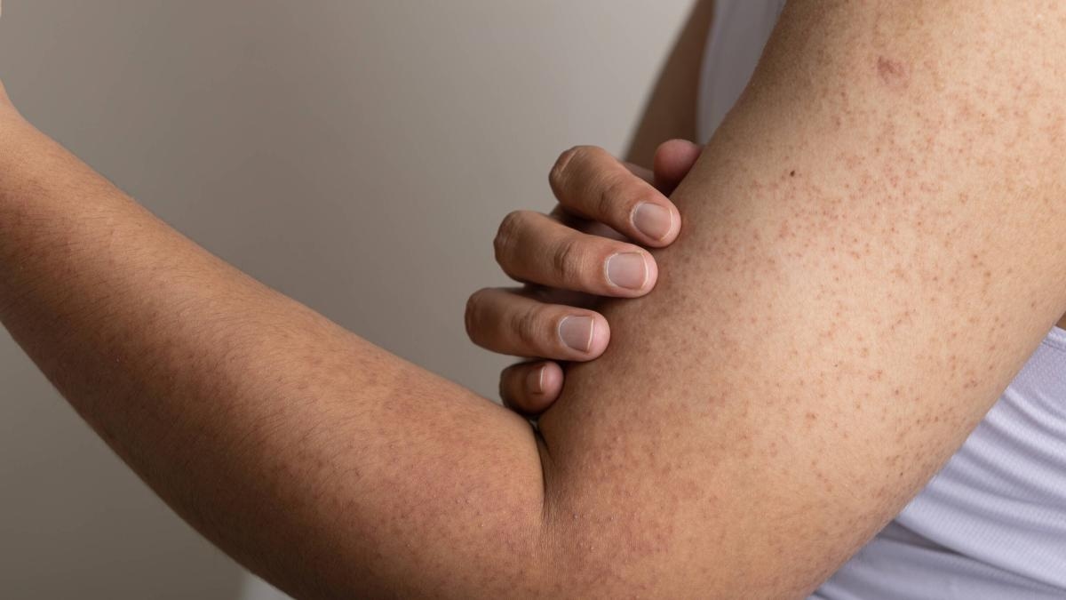 Come sbarazzarsi della pelle di pollo sulle braccia: il trucco definitivo, secondo gli esperti della Mayo Clinic.