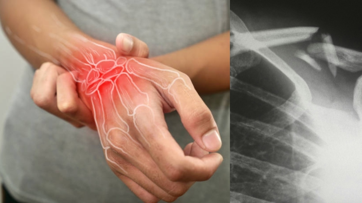 Dia Mundial da Osteoporose: uma doença silenciosa que afeta a qualidade de vida