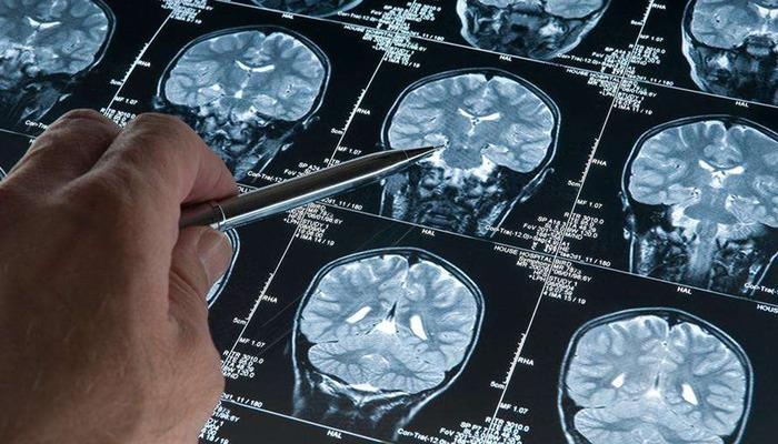 Verborgen gevaar bij mannen! In Alzheimer-onderzoek is een genetische variant gevonden die het risico op dementie verhoogt: de kans om deze variant te ontwikkelen bij mannen is 2,39