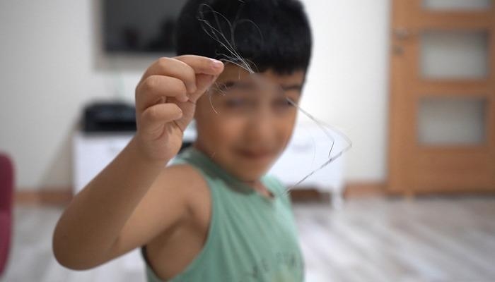 It was revealed 3 years later: They forgot the 18-centimeter catheter! It appeared after swallowing a cucumber