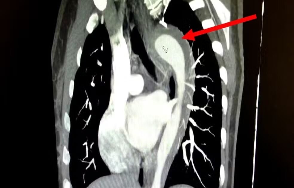 Em caso raro, mulher rompe aorta em relação sexual
