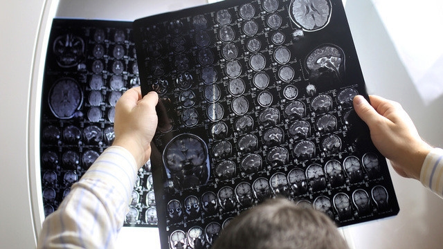 Gli scienziati hanno spiegato perché gli asmatici hanno meno probabilità di soffrire di tumori al cervello.