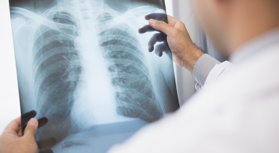 El 50% de los pacientes con cáncer de pulmón tienen más de 70 años