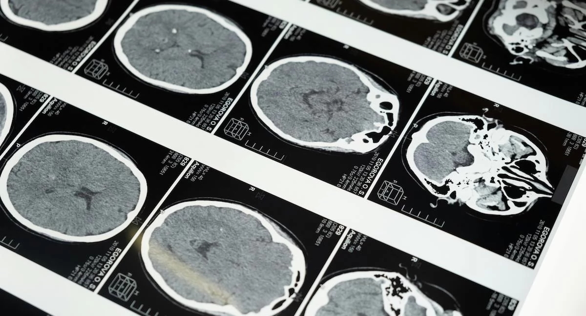 Veroudering van de hersenen kan een voorbode zijn van schizofrenie. Wetenschappers hebben een biomarker ontdekt