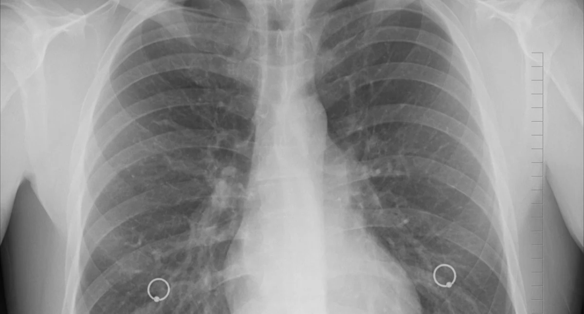Radioterapia z pomocą algorytmu. AI poprawia dokładność leczenia raka płuc