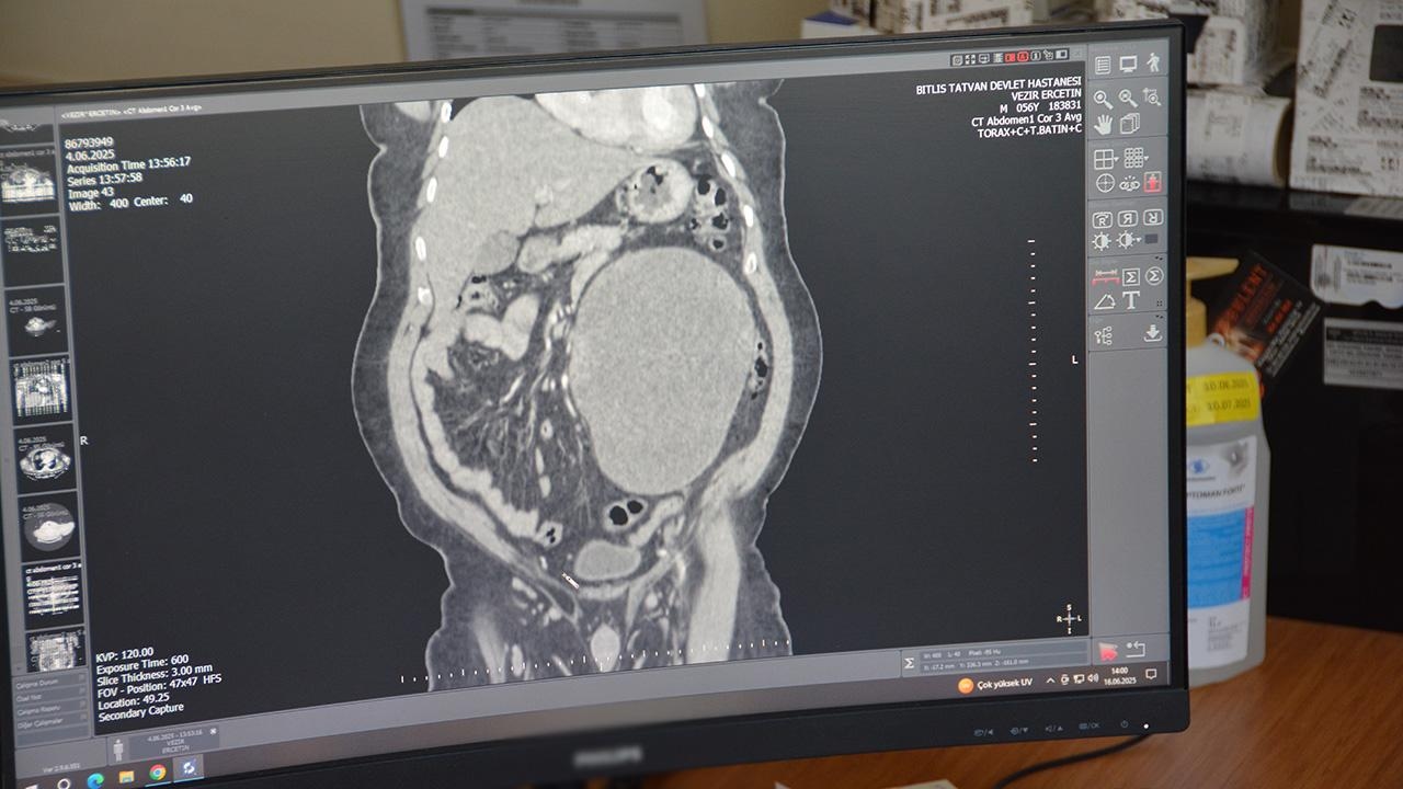 Ele foi ao médico com queixa de dor abdominal e foi encontrado um cisto de 23 cm no rim.