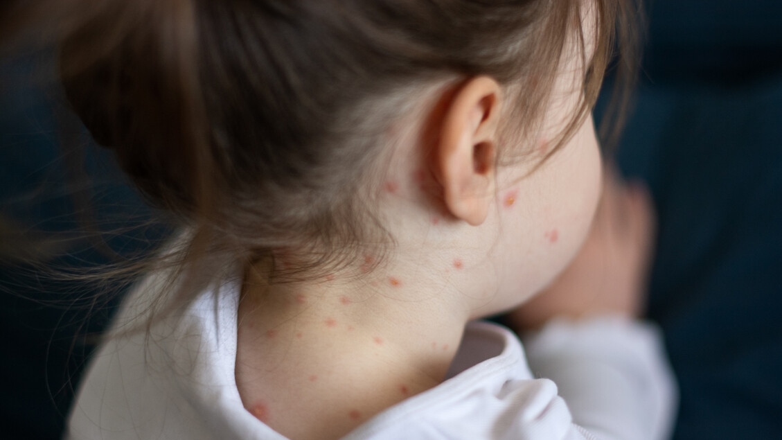 Negli Usa allerta morbillo, i casi ai massimi dal 1992