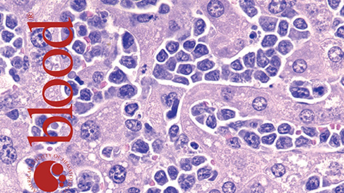 Leucemia pediátrica aguda: uma possível opção de tratamento para uma forma que afeta principalmente crianças com Síndrome de Down.