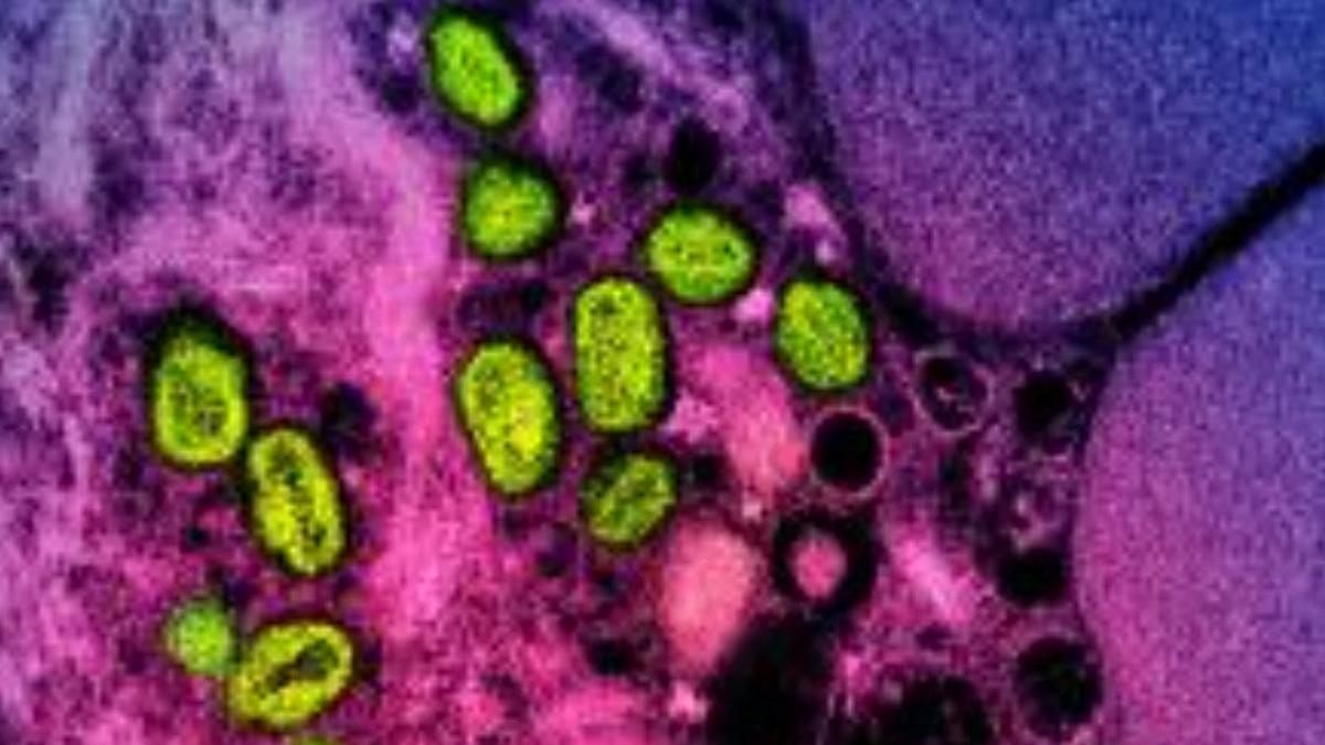 Spanien meldet den ersten Todesfall durch MPOX (Affenpocken) seit 2022.
