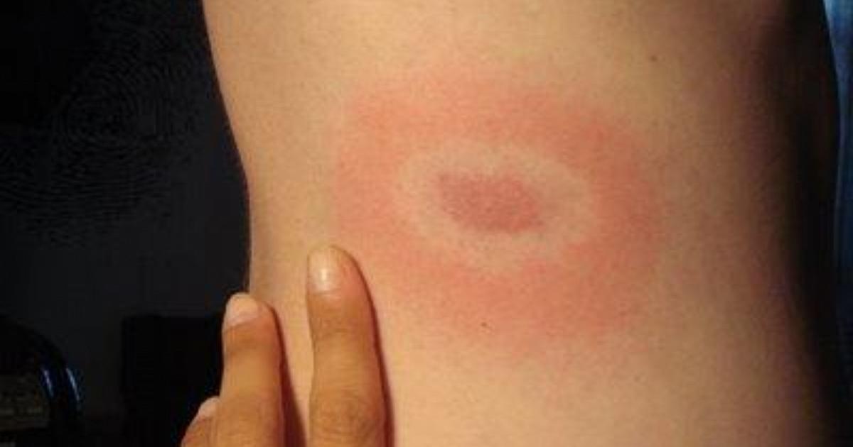 Borreliose: Ansteckung, Verlauf und Behandlung