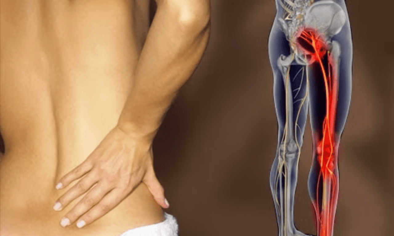 Siyatik ağrısı: Nasıl teşhis edilir, nedenleri nelerdir ve nasıl hafifletilir?