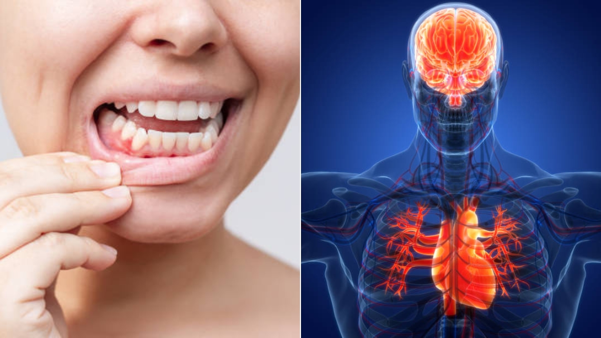 Ecco il pericoloso legame tra gengive malate e ictus, confermato da uno studio