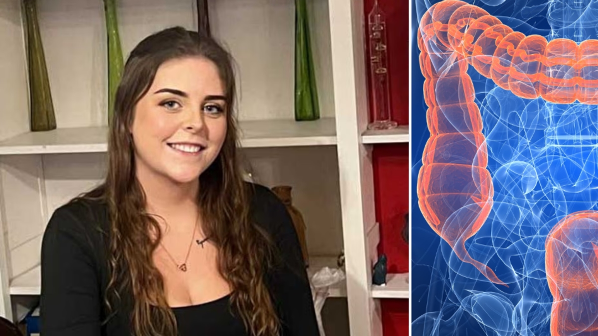 Adolescente de 19 años fue diagnosticada con cáncer de intestino en etapa 3 después de que los médicos lo descartaran 13 veces por ser muy joven